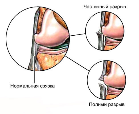 Вивих ноги в районі щиколотки: симптоми і лікування вивиху гомілковостопного суглоба