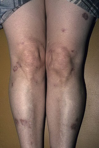 Ліпоїдний некробіоз шкіри: причини, симптоми, лікування, фото до і після