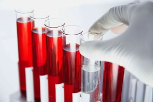 Ревмопроби: норми і розшифровка, як здавати аналіз крові на ревмопроби
