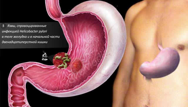 Виразка шлунка: симптоми, ознаки, методи діагностики і фактори, що провокують розвиток виразки