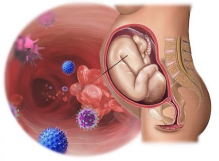 Гонорея при вагітності: симптоми, лікування, наслідки для плода