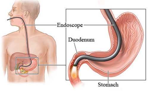 ЕГДС шлунка: коли показана, підготовка, специфіка проведення, відгуки