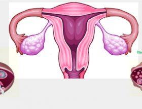 Полікістоз яєчників: причини і лікування, прогноз вагітності