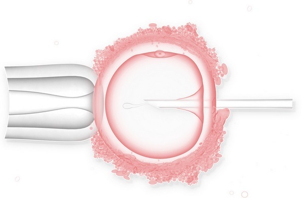 ІКСІ-запліднення: що це таке, відміну ЕКО і ІКСІ, вагітність при ІКСІ