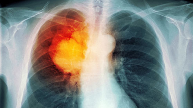 Перші ознаки раку легені: стадії раку легенів, діагностика та фактори, що сприяють розвитку раку легенів