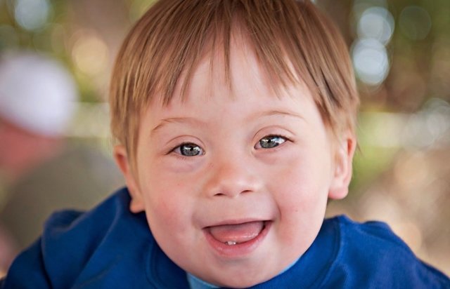 Синдром Дауна: причини, як визначити новонародженого з синдромом Дауна, патології дитини з синдромом Дауна