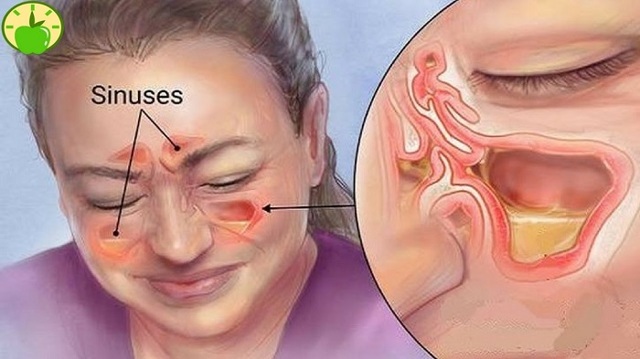 Болить ніс і голова: причини, яка зв'язок, правильна діагностика