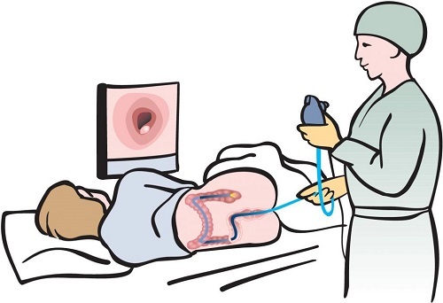 Колоноскопія: суть методу, показання та правила підготовки до процедури | ОкейДок
