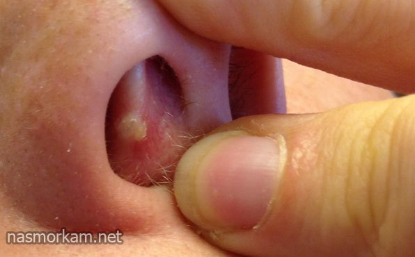 Болить ніс всередині, зовні, кінчик при натисканні або дотику: причини і лікування