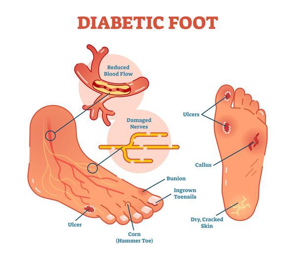 Діабетична стопа: симптоми і лікування, стадії діабетичної стопи, догляд зав ногами при цукровому діабеті