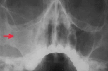 Рентген носа: як часто можна робити, що показує і правила проведення