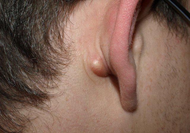 Ліпома вуха: що це таке, причини, симптоми, лікування жировика мочки вуха