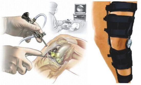 Артроскопія суставов- операція, підготовка, відновлення після артроскопії