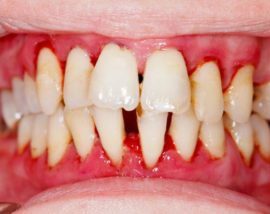 Присмак крові в роті: причини, що це означає, присмак після фізичного навантаження