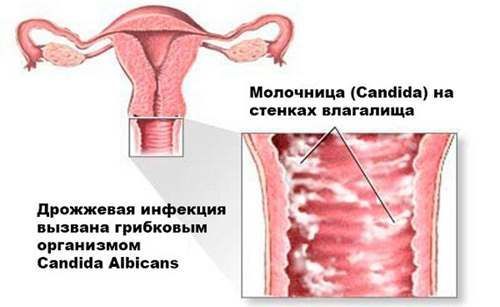Флюкостат при молочниці: як приймати жінкам і чоловікам, інструкція із застосування