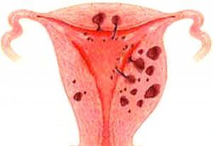 Чи можливо завагітніти при ендометріозі матки: 1 або 2 ступеня