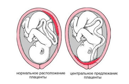 Кров'янисті виділення до пологів, кровотеча в третьому триместрі вагітності: що це значить