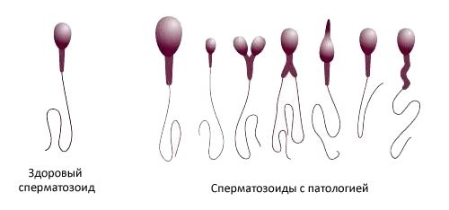 Види патологій сперми і лікування чоловічого безпліддя: нові методики і можливості репродуктивної медицини 