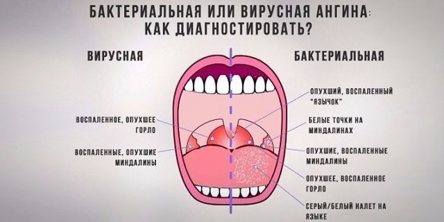 Скільки лікується ангіна (тонзиліт) у дітей і дорослих: як довго болить горло?