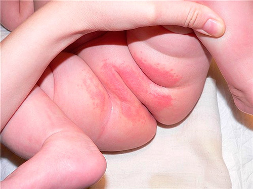 Генітальна алергія: симптоми, лікування алергії статевих органів