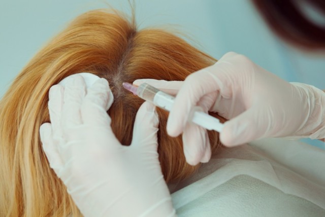 Плазмотерапія для особи і для волосся: що це таке, переваги та особливості процедури, фото до і після