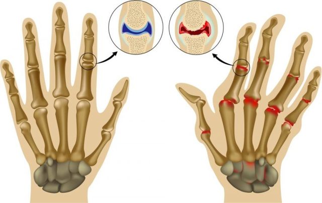 Артрит пальців рук: причини, симптоми і лікування, народні засоби