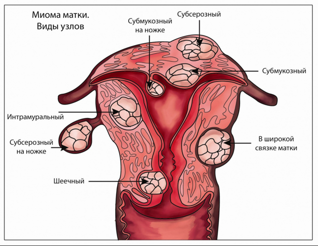 Гістеректомія матки в гінекології: що це таке, наслідки видалення матки