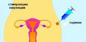 Стимуляція яєчників для планування вагітності