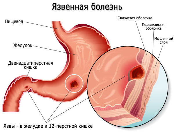 Гастроскопия (ЕГДС): що показує, підготовка і проведення дослідження