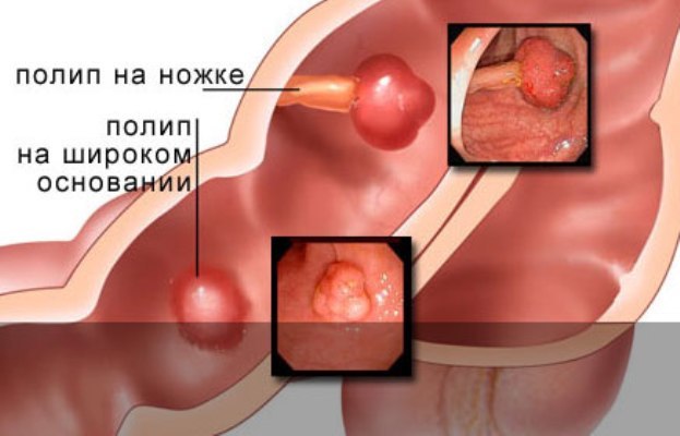 Поліп шлунка: симптоми, лікування, причини захворювання, діагностика, рецепти народної медицини, профілактика і дієта.