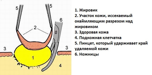 Ліпома вуха: що це таке, причини, симптоми, лікування жировика мочки вуха