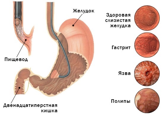 ЕГДС шлунка: коли показана, підготовка, специфіка проведення, відгуки