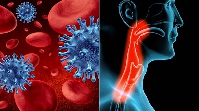 Рак горла: симптоми і прояви на різних стадіях у чоловіків і жінок