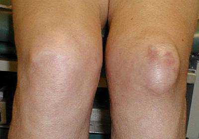 Бурсит колінного суглоба: симптоми і лікування, що це за патологія, причини