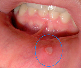 Присмак крові в роті: причини, що це означає, присмак після фізичного навантаження