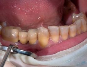 Тетрациклінові зуби: загальне розуміння суті проблеми, методи лікування і відбілювання