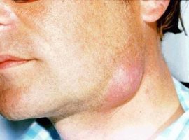 Запалення лімфовузлів під щелепою: причини і лікування