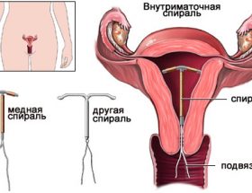 Внутрішньоматкова контрацепція: плюси і мінуси методу, класифікація спіралей, можливі наслідки
