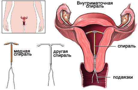 Внутрішньоматкова контрацепція: плюси і мінуси методу, класифікація спіралей, можливі наслідки