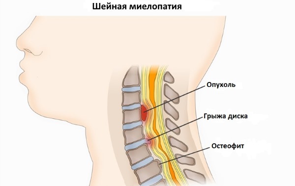 Шум, дзвін у вухах при остеохондрозі шийного відділу: лікування, причини, симптоми