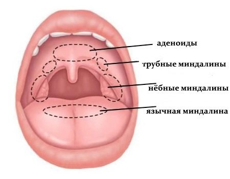 Кіста на мигдалині: причини, симптоми і лікування з операцією і без