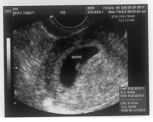 6 тиждень вагітності: що відбувається, узі, виділення, відчуття, плід на 6 тижні