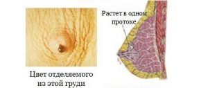 Папіломи під грудними залозами: симптоми внутрипротокового папилломатоза