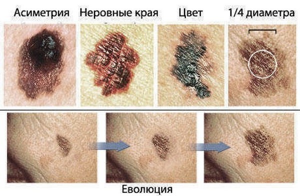 Видалення новоутворень на шкірі: показання, сучасні методики видалення новоутворень на шкірі, найефективніші методики видалення родимок та ін. 
