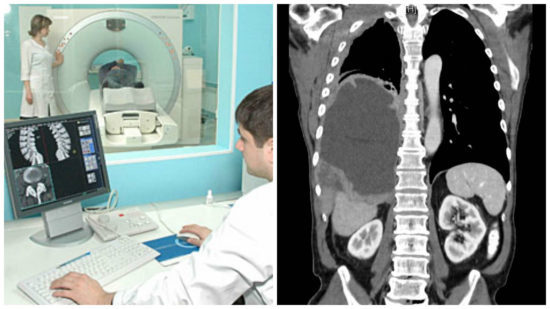 Комп'ютерна томографія хребта при міжхребцевої грижі: необхідність і шкода процедури 