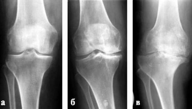 Посттравматичний артроз колінного суглоба: ступеня, симптоми, лікування