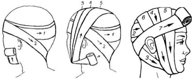 Перша допомога при пораненні голови: пов'язка, обробка рани при пораненні волосистої частини голови