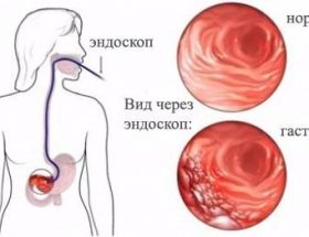 Чим зняти біль в підребер'ї і температуру в 60 років?