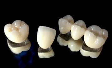 Коронки на зуби: які бувають, які краще, плюси і мінуси коронок