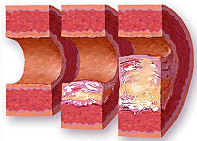 Методи очищення судин від холестерину, атеросклеротичних бляшок і тромбів